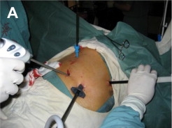 Esofagectomía toracoscópica mostrando paciente
