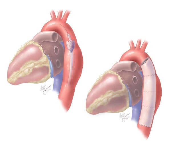 Endovascular Repair of Aneurysm of Descending Thoracic Aorta