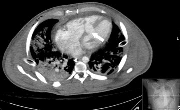 Computed tomographic scan of the chest revealing the ventricular septal defect (white arrow)