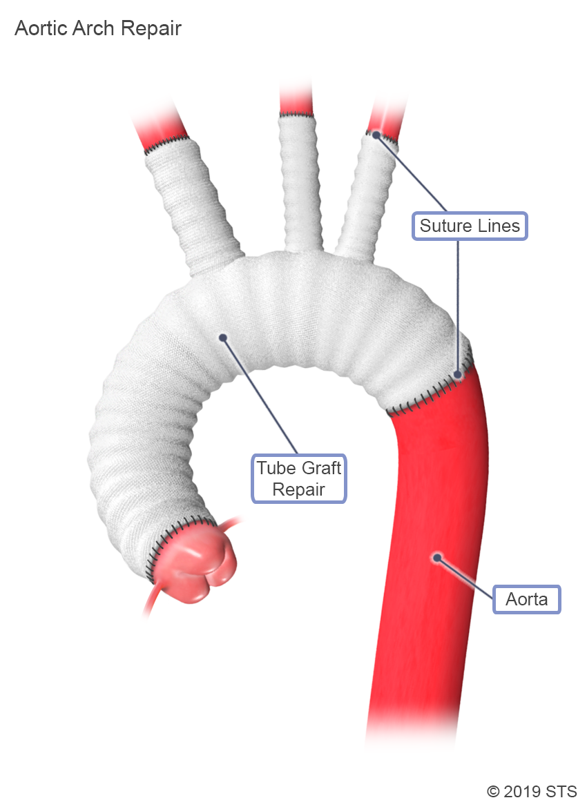 Thoracic Aortic Aneurysm The Patient Guide To Heart Lung And