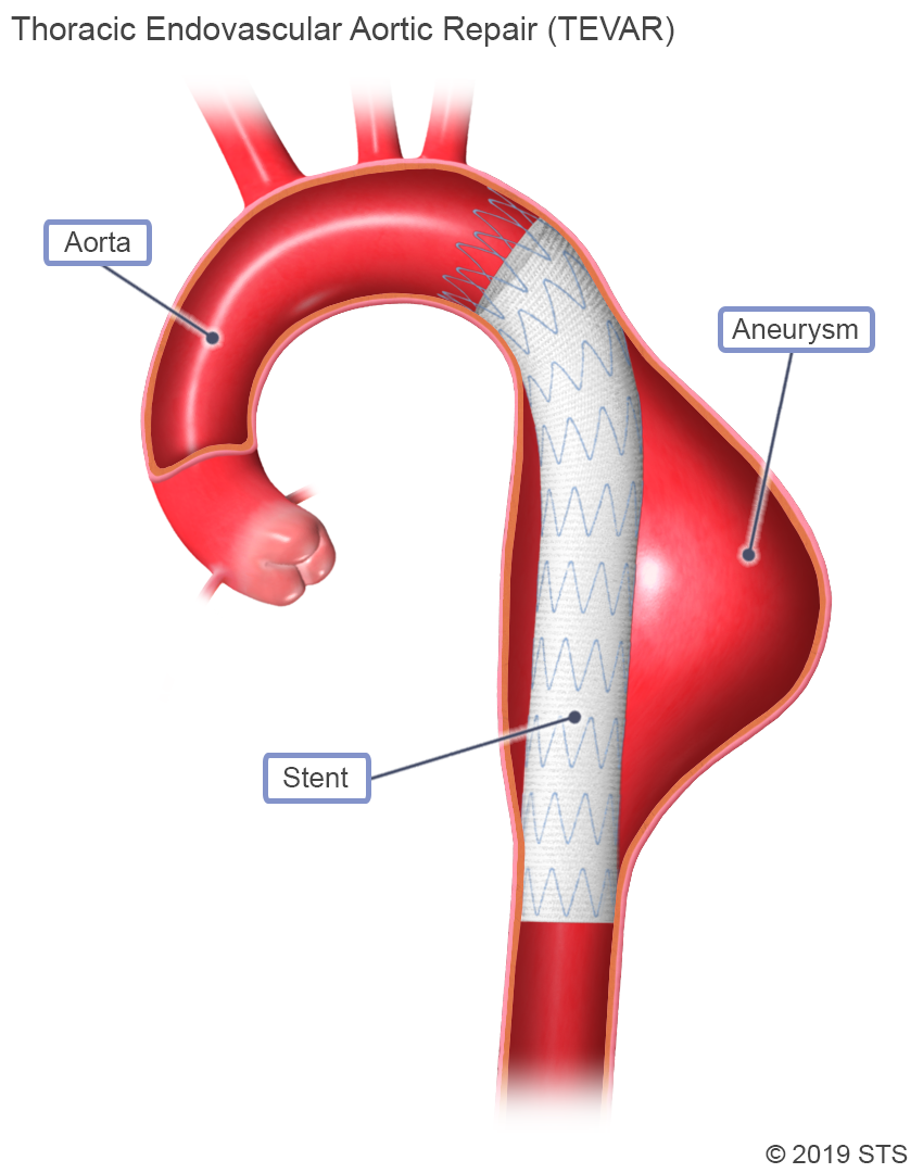 Thoracic Aortic Aneurysm The Patient Guide To Heart Lung And