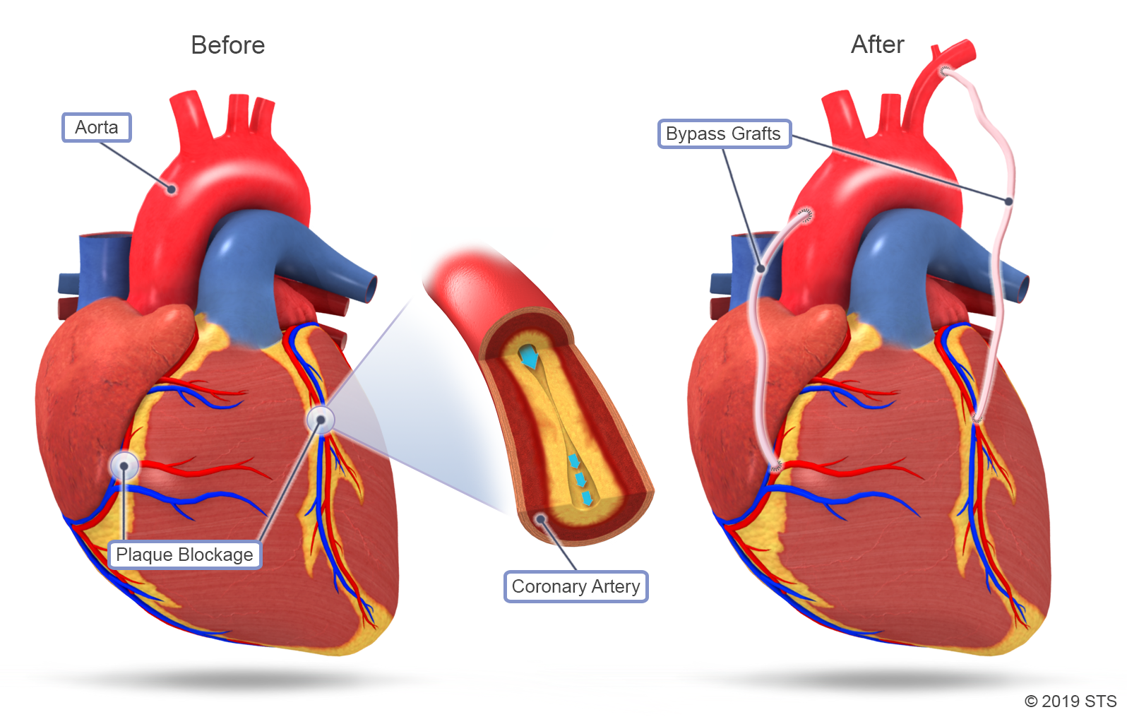 Что такое шунтирование сердца и сосудов. Коронарное шунтирование. Шунтирование коронарных артерий. Аортокоронарного шунтирования. Аорто-коронарное шунтирование.