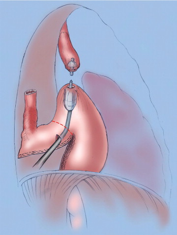 Conexión durante una esofagectomía transtorácica