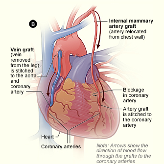 La figura B muestra como se unen al corazón los injertos baipás de venas y arterias.