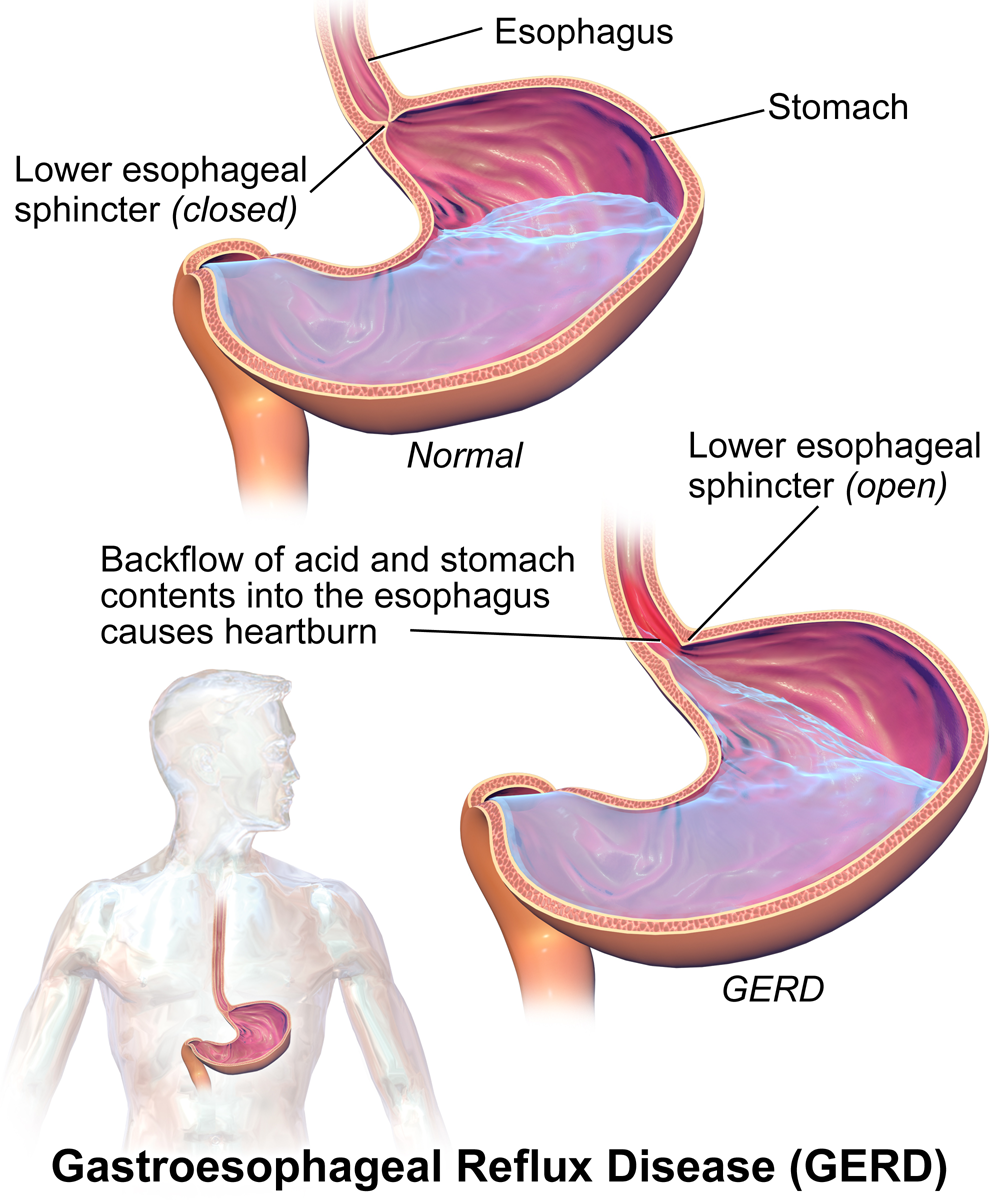 Gastroesophageal Reflux Disease   The Patient Guide to Heart, Lung ...