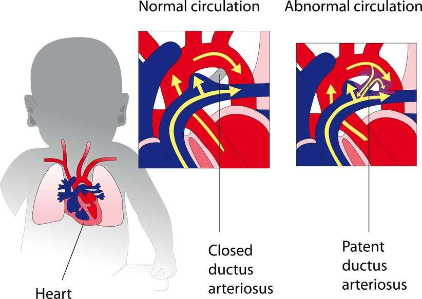 Patent Ductus Arteriosus | The Patient Guide to Heart, Lung, and ...