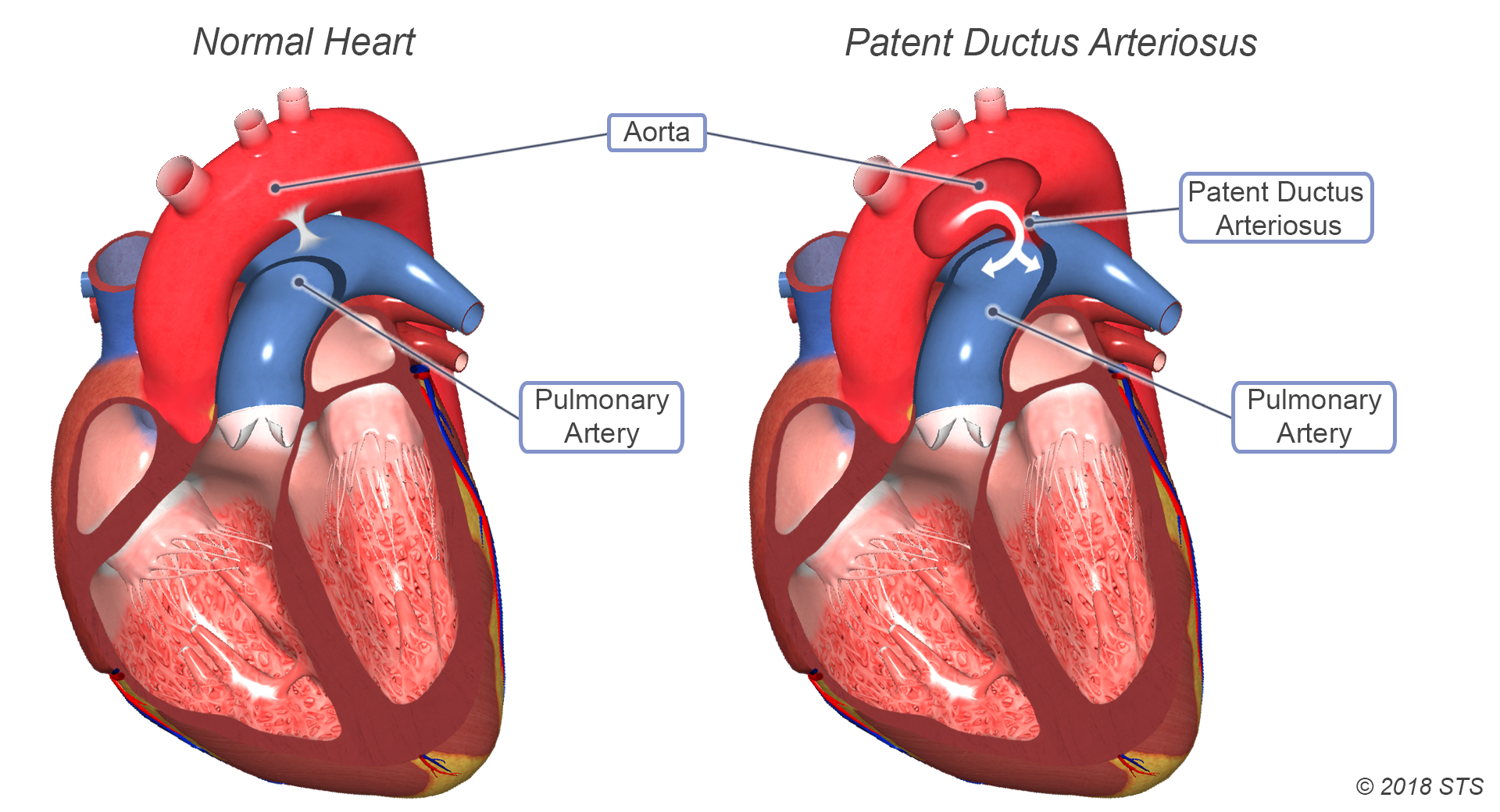 Patent Ductus Arteriosus (PDA)