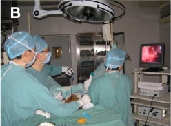 Equipo quirúrgico realiza una esofagectomía toracoscópica