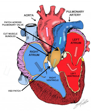 Tetralogy of Fallot | The Patient Guide to Heart, Lung, and Esophageal ...