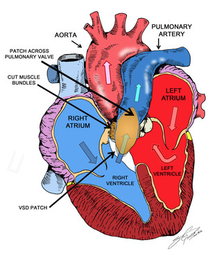 Ilustración de un corazón con una CIV reparada