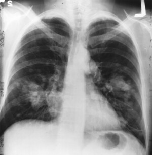Chest x-ray showing lung cancer 