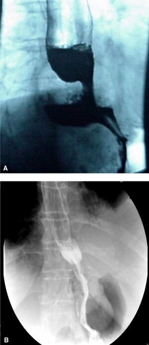 Deglución de bario antes (A) y después (B) de la cirugía