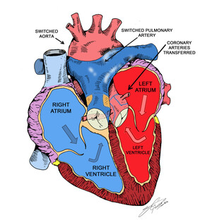 Illustration of heart with repaired TGA