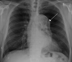A stent placed in the thoracic aorta 