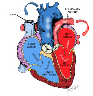 Illustration of Transpostion of Great Arteries