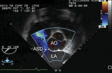 Resultados de una ecocardiografía mostrando comunicación interauricular