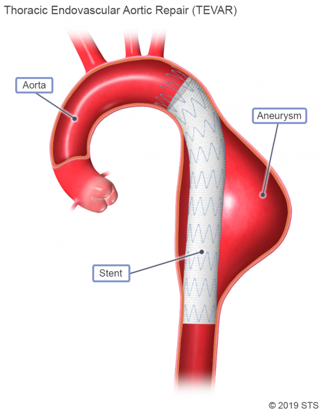 Thoracic Aortic Aneurysm | The Patient Guide To Heart, Lung, And ...