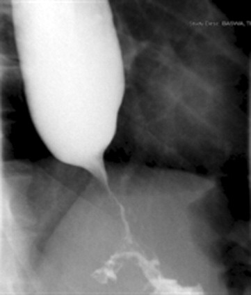 Barium esophagogram demonstrating marked dysmotility