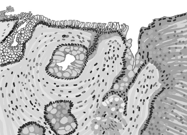 Drawing of a microscopic piece of the esophagus showing the abnormal tissue of Barrett’s esophagus.