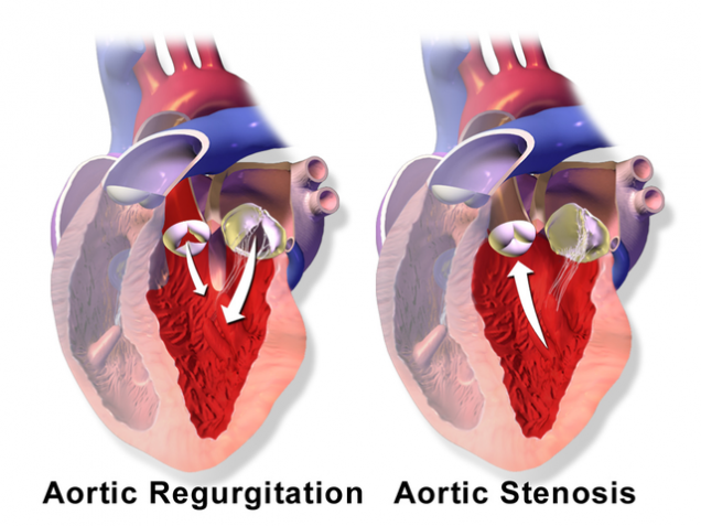 Aortic Valve Disease The Patient Guide To Heart Lung And Esophageal