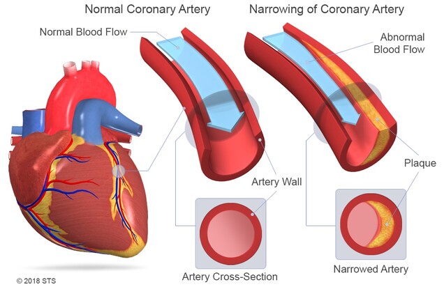 Cuidar falta película Enfermedad de las arterias coronarias | La Guía del Paciente para Corazón,  los Pulmones y la cirugía esofágica