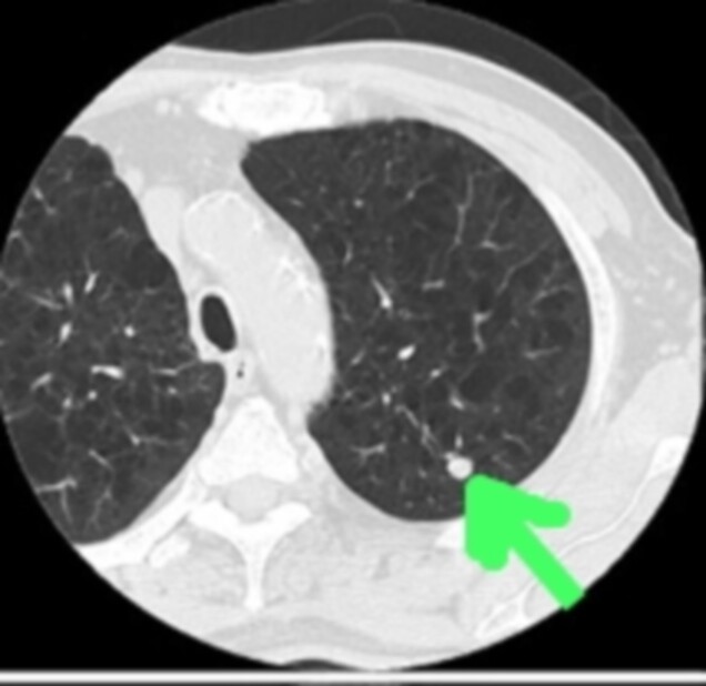 CT scan showing lung cancer