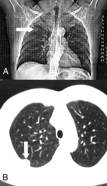 CT scan reveals tumor in the chest wall (arrows)