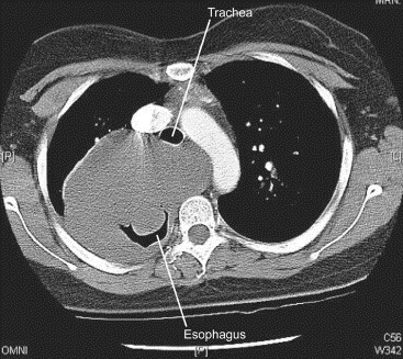 CT scan showing a large mediastinal mass