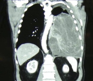 CT scan showing giant compressive malignant fibrous tumor of the pleura