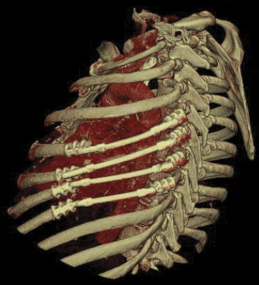 3D CT reconstruction showing titanium rib bridges