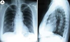 Radiografía de tórax mostrando un tumor fibroso benigno de la pleura