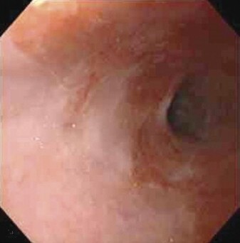 Endoscopic view of Barrett’s esophagus