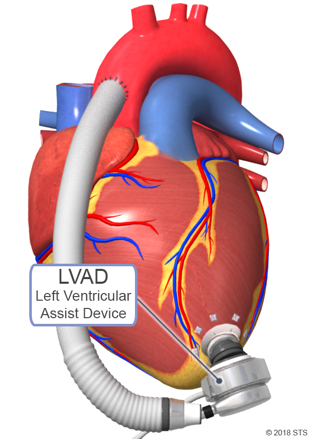 Left Ventricular Assist Device (LVAD) | The Patient Guide To Heart ...