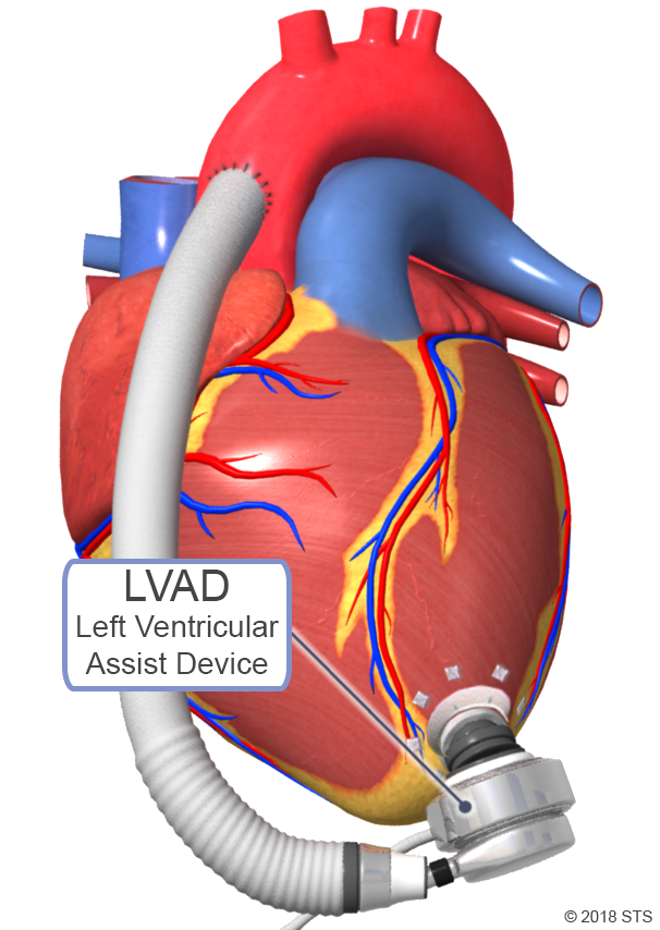 Сколько весит искусственный левый желудочек для сердца. Искусственное сердце аппарат. Искусственный желудочек сердца.