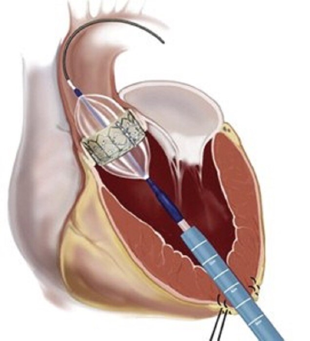 Transcatheter Aortic Valve Replacement Is Safe, Effective for Very Elderly  Patients | The Patient Guide to Heart, Lung, and Esophageal Surgery