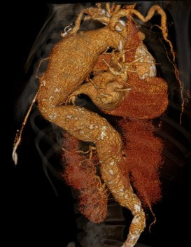 3D CT reconstruction of a descending thoracic aneurysm