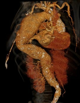 La reconstrucción 3D de TC de un aneurisma de aorta torácica descendente