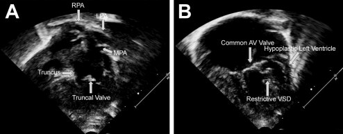 Imagen ecocardiograma transtorácico bidimensional apical de las cuatro cámaras mostrando el tronco arterial tipo 1