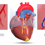 Coronary Artery Bypass Grafting (CABG) | The Patient Guide to Heart ...