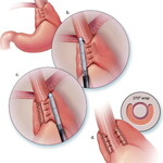 Funduplicatura parcial laparoscópica 
