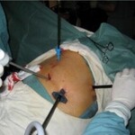 Esofagectomía toracoscópica mostrando paciente